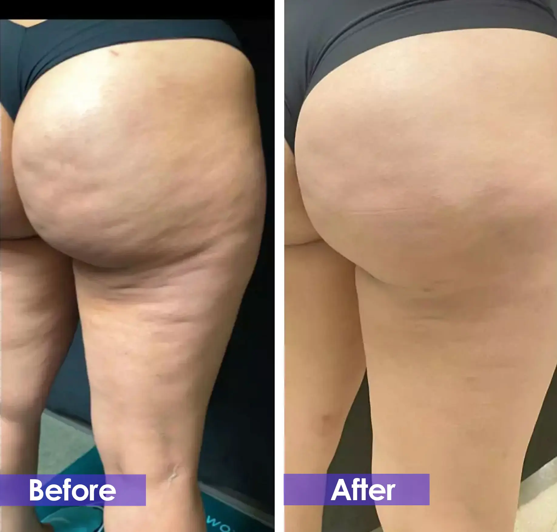 velashape treatment Before and after:  female buttocks with Smoother